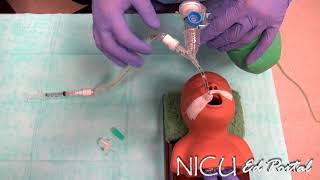 NICU Procedures Surfactant administration in a preterm infant [upl. by Htesil]