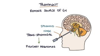 Understanding Acromegaly [upl. by Yarezed]