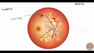 Diabetic Retinopathy for USMLE Step 1 and USMLE Step 2 [upl. by Yoho327]