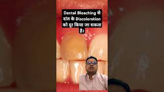 Dental Bleaching से दांत के Discoloration को दूर किया जा सकता है। DentalBleaching Bleachig [upl. by Ekle]