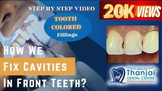 How to fix cavities between front teeth Composite filling video How dentist remove tooth decay [upl. by Zachar]