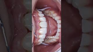 Veneers vs Crown  Front Teeth  Aesthetic  Dentistry [upl. by Hestia]