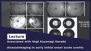 Associated with Vogt Koyanagi Harada diseaseImaging in early initial onset acute uveitis [upl. by Ahsiad]