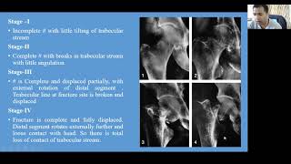 femur neck fracture [upl. by Inoy]