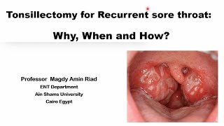 Tonsillectomy for Recurrent sore throat Why When and How [upl. by Arahs688]