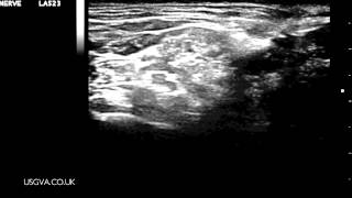 Ultrasound Guided Interscalene Brachial Plexus Block [upl. by Olin743]