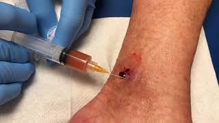 PRP for chronic venous ulcer [upl. by Ahsiad]