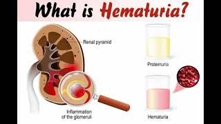 Haematuria Red urine mrcpch Clinical [upl. by Enrobialc]