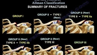 Clavicle Fractures Classification  Everything You Need To Know  Dr Nabil Ebraheim [upl. by Emmy]