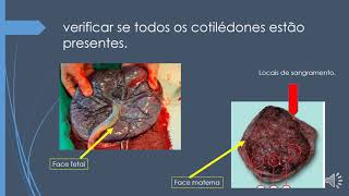 Emergências Obstétricas parto pelvico video 7 [upl. by Iarised]