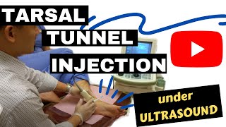 Tarsal tunnel injection under ultrasound [upl. by Cosma661]