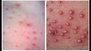 Home Remedies for Folliculitis  How to Get Rid of Folliculitis At Home [upl. by Anoit]