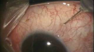 Intravitreal avastin injection Khaled Abdelgalil Shalaby MD [upl. by Osy]