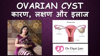 OVARIAN CYST ओवरी में गाँठ  सिस्ट HINDI Gynaecologist Dr Dipti Jain Ahmedabad [upl. by Nav558]