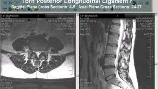 Torn Posterior Longitudinal Ligament [upl. by Alleen]