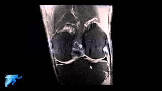 How to Read Knee MRI of Normal Knee  Anatomy of the Knee  Complex Knee Surgeon  Minneapolis  MN [upl. by Guibert449]