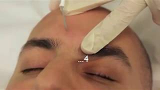 Sebaceous Hyperplasia Treatment using Electrodessication [upl. by Elreath]