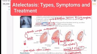 Atelectasis Types Symptoms and Treatment Respiratory 51  First Aid USMLE Step 1 in UrduHindi [upl. by Salomone]