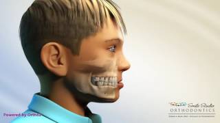 Facemask With Hyrax  Orthodontic Device [upl. by Iver934]