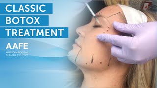 Full Face Botox Treatment  AAFE [upl. by Ellesij795]