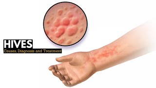 HIVES Causes Signs and Symptoms Diagnosis and Treatment [upl. by Riki728]