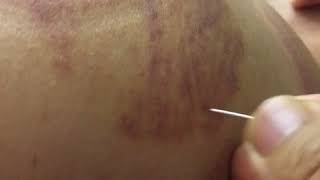 Dry Needling for Axillary Nerve [upl. by Alma]