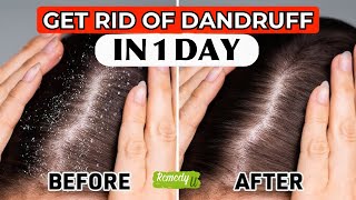 Dandruff Destroyer FAST 1 Day Remedies to Say Goodbye [upl. by Brunella]