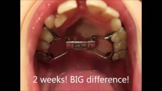 Rapid Maxillary Expansion RME  12 months in a few minutes [upl. by Idisahc799]