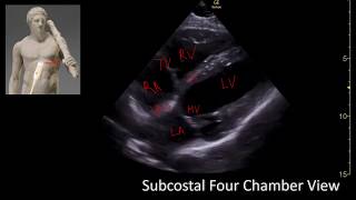 Subcostal Four chamber View Perioperative amp Critical Care ECHO POCUS [upl. by Eedyah890]