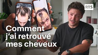 Les greffes de cheveux séduisent de plus en plus face à la calvitie  RTS [upl. by Isleen]