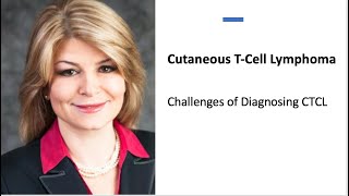 Challenges of Diagnosing CTCL Chapter 1 [upl. by Anirdnajela979]