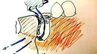 Suturing a membrane to the periostium for a one wall defect bone graft around dental implant [upl. by Whiney955]