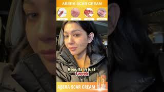 Healing Wounds amp Boosting Skin Health with Abera Cream scarcream damagedskinrepair Abera [upl. by Aihtibat]