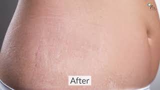 Stretch Mark Removal Cream Fixderma Strallium Stretch Marks Cream [upl. by Olivann504]