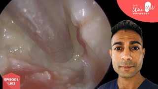 1102  Nasty 5 Year Ear Infection Microsuction [upl. by Eatnoid]