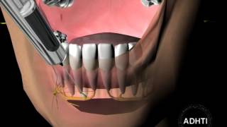 инфильтрационная анестезия на нижней челюстиinfiltration anesthesia in the mandible [upl. by Ecirum]