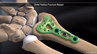 Distal Radius Fracture Repair [upl. by Ammadis]