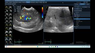 IQ 279 LIVER ULTRASOUND HEPATOMA ECHOPAC ANALYSIS ECHOCARDIOGRAPHY COLOR FLOW MAMMING [upl. by Akenaj603]