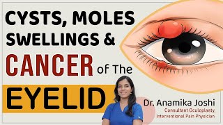 What are these swellings around the eye   Eyelid  Swellings on eyelid  Dr Anamika Joshi [upl. by Ranjiv]