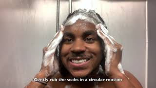 Hair Transplant  How to Wash Scabs Off and After Results [upl. by Adelle983]