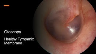 Tympanic Membrane Otosopy [upl. by Biggs]