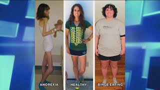 How an Anorexic Can Become a Binge Eater [upl. by Airyk]