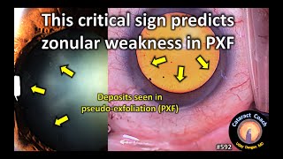 This critical sign predicts zonular weakness in PseudoExfoliation [upl. by Icnarf]