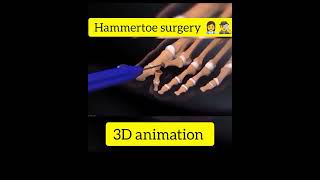 Hammertoe surgery 👩‍⚕️ 🕵️‍♂️youtube 3danimationsurgery youtubeshorts lifecaretv1 [upl. by Anaiuq]