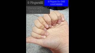 Major polydactyly 9 fingers on one hand [upl. by Aciraj]