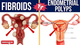 SIMILARITIES AND DIFFERENCES BETWEEN FIBROID AND ENDOMETRIAL POLYPSfibroid endometrium [upl. by Sondra]