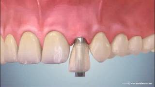 Anew Implants Upper Single Tooth Installation [upl. by Dagall125]