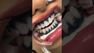 teeth whitening process 🦷 torontoteethwhitening teethwhitening [upl. by Crosse42]