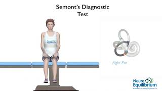 Semont Maneuver A Step by Step Guide to Treat BPPV Vertigo [upl. by Adis]