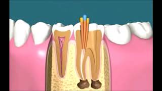 Endodoncia paso a paso  Caredent Albacete [upl. by Vowel]